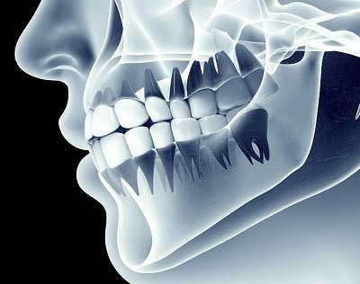 Tomografía dental 3D en Torrevieja