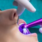 Blanqueamiento dental con laser