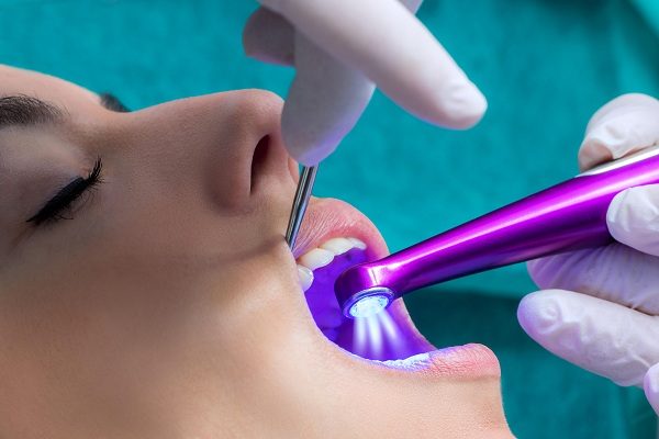 Blanqueamiento dental con laser