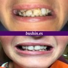 Reconstrucción estética de dientes