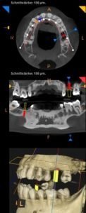 Tomogramas 3D para la elevación del seno maxilar 